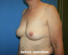 plastic-surgery-breast-augmentation